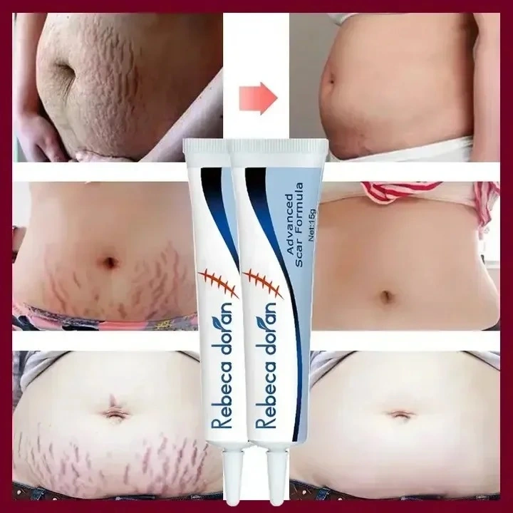 Surgical & Burn Scar Removal Cream – Fast Skin Recovery - Image 2
