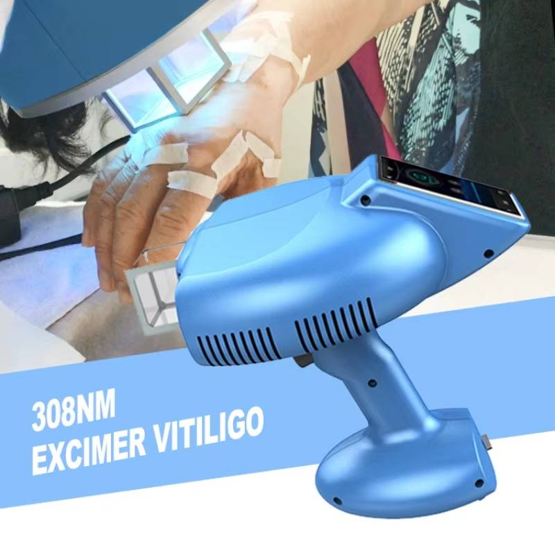 308nm Excimer Laser Vitiligo Machine | Advanced Skin Therapy - Image 2